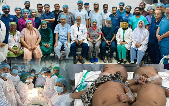শিশু রুহি আর জুহিকে সফল ভাবে আলাদা করা হয়েছে
