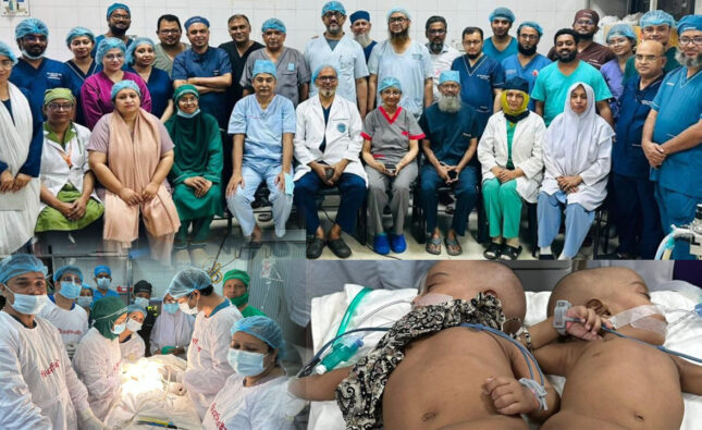 শিশু রুহি আর জুহিকে সফল ভাবে আলাদা করা হয়েছে