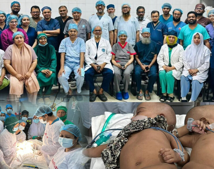 শিশু রুহি আর জুহিকে সফল ভাবে আলাদা করা হয়েছে